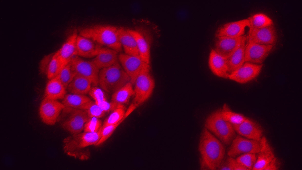 Ovarian cancer cells under a microscopes and illuminated red, purple, and pink